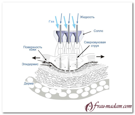 газожидкостный пилинг лица