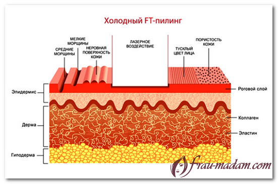 глубокий лазерный пилинг